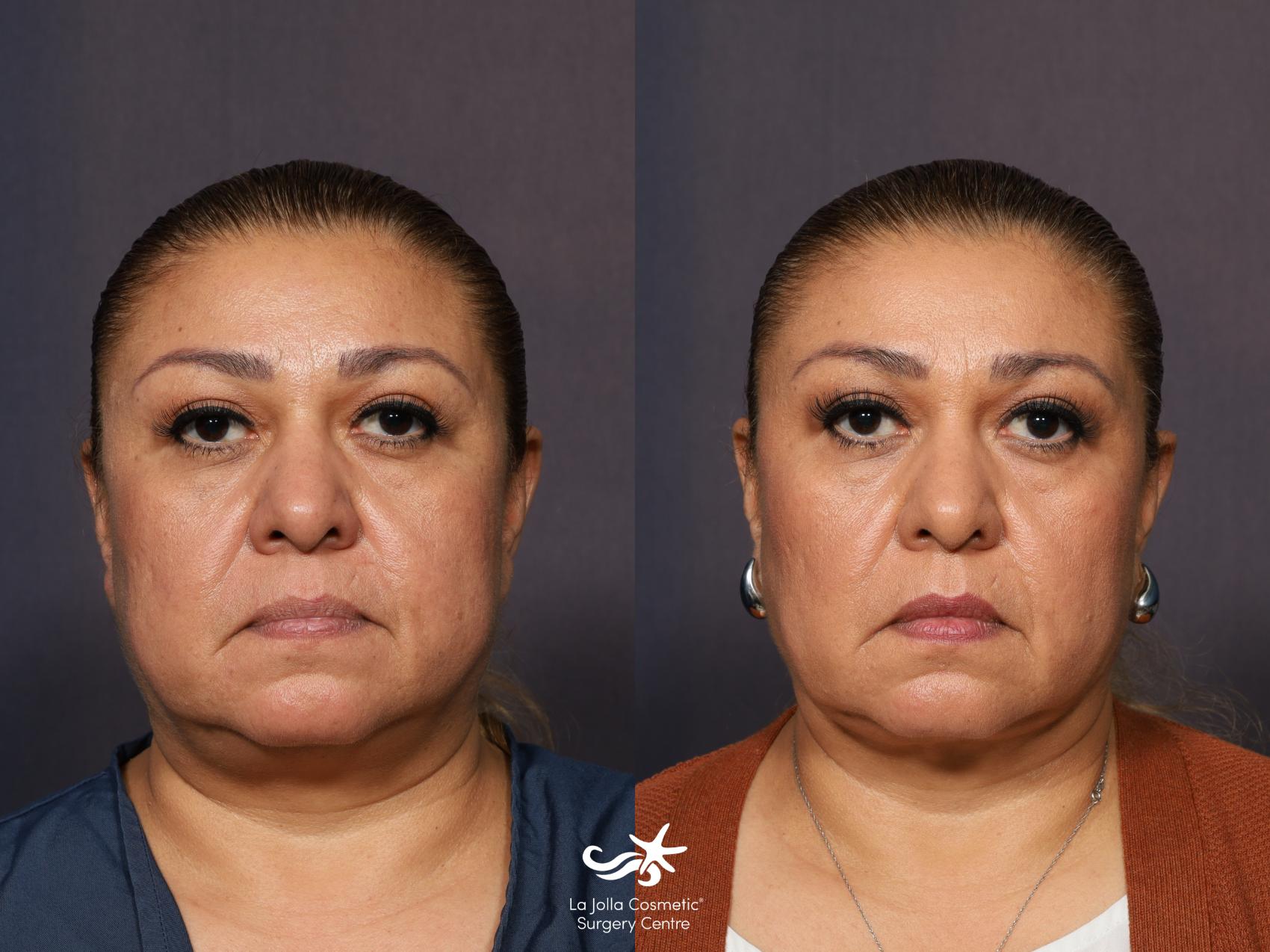 buccal fat removal price buccal fat removal price