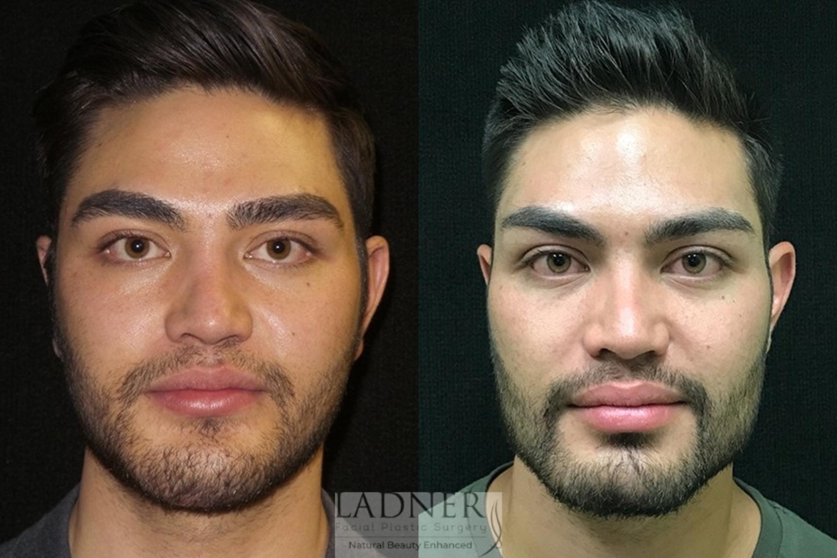 buccal fat removal price buccal fat removal price
