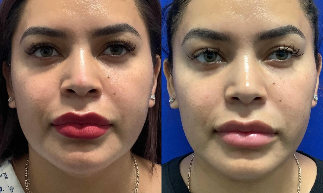 buccal fat removal price buccal fat removal price