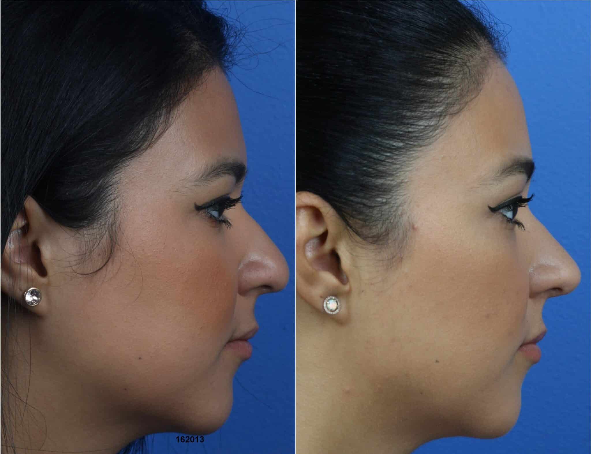 buccal lipectomy