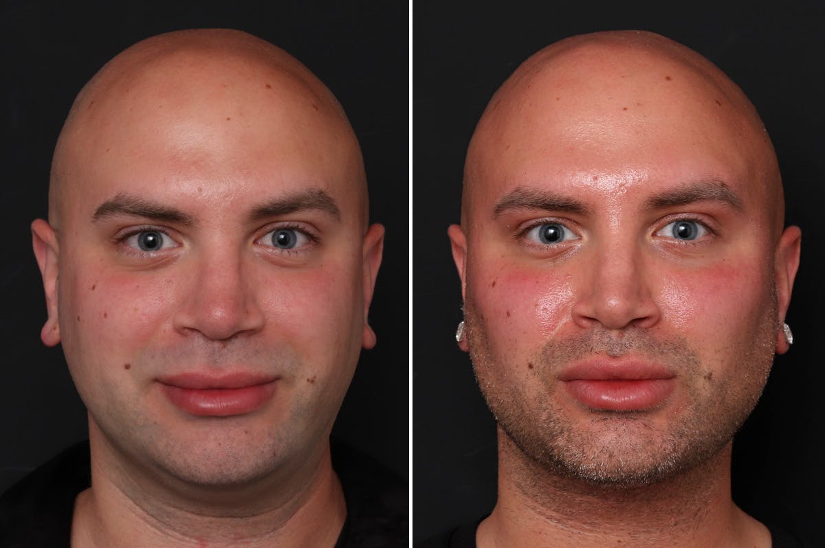 buccal lipectomy