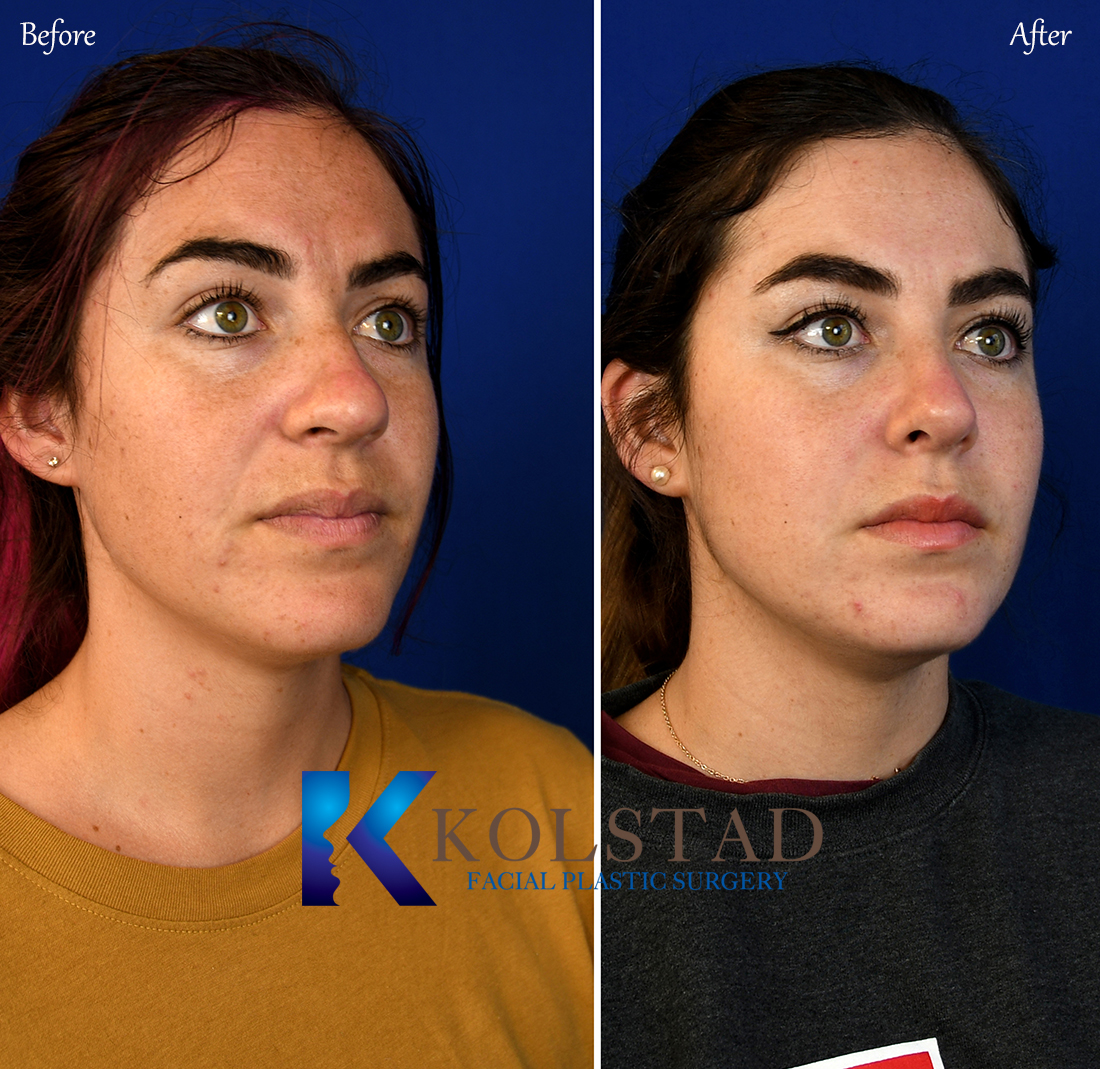 bulbous nose job
