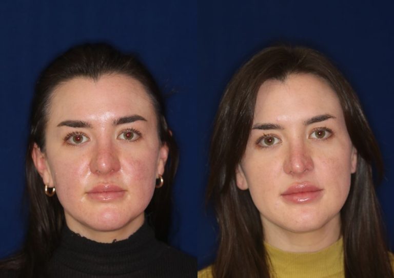Bulbous nose job: Refining the nasal tip for balanced proportions