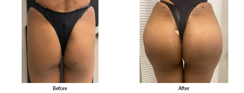 butt enhancement