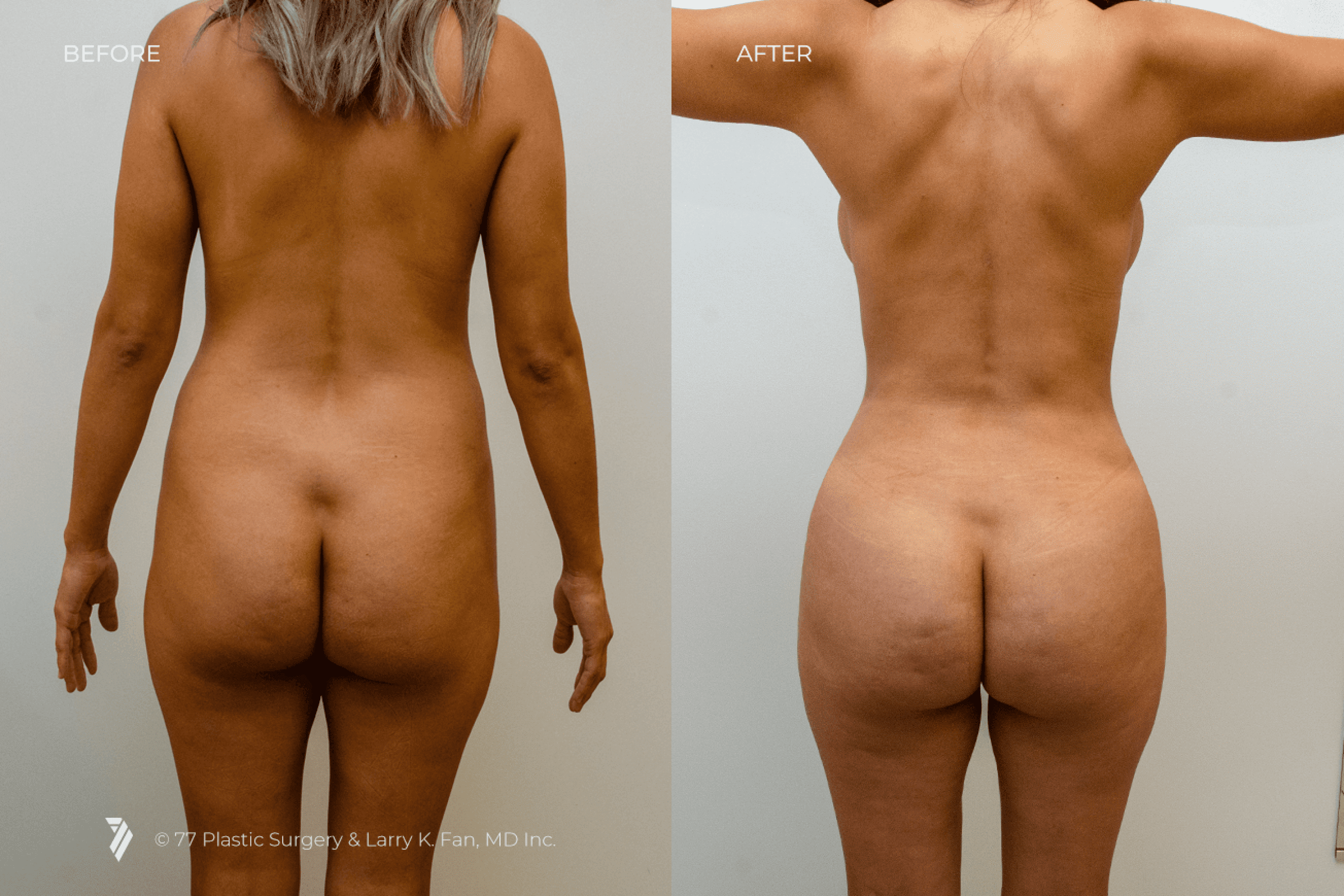 butt enhancement