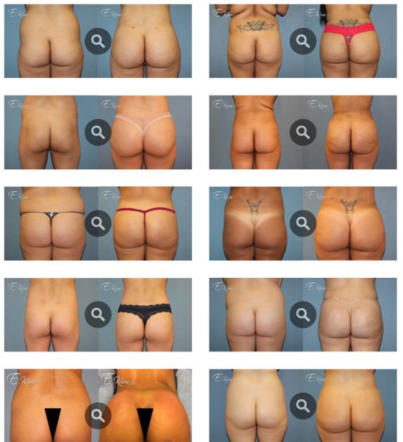 butt implant