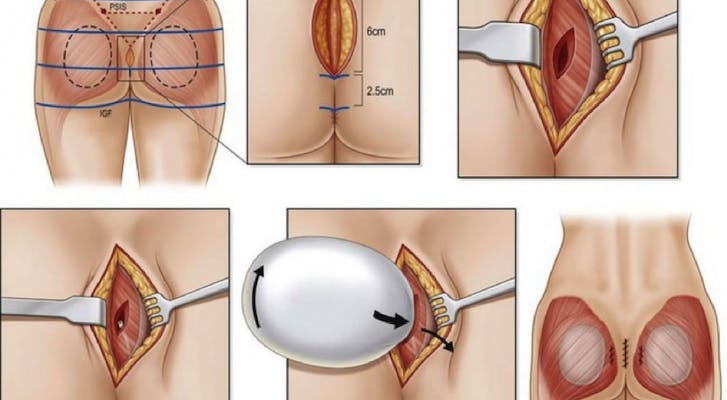butt implant