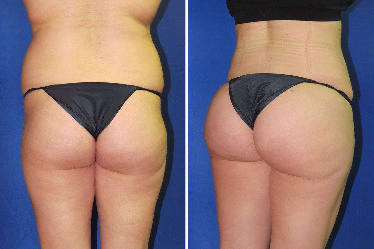 butt injections cost butt injections cost