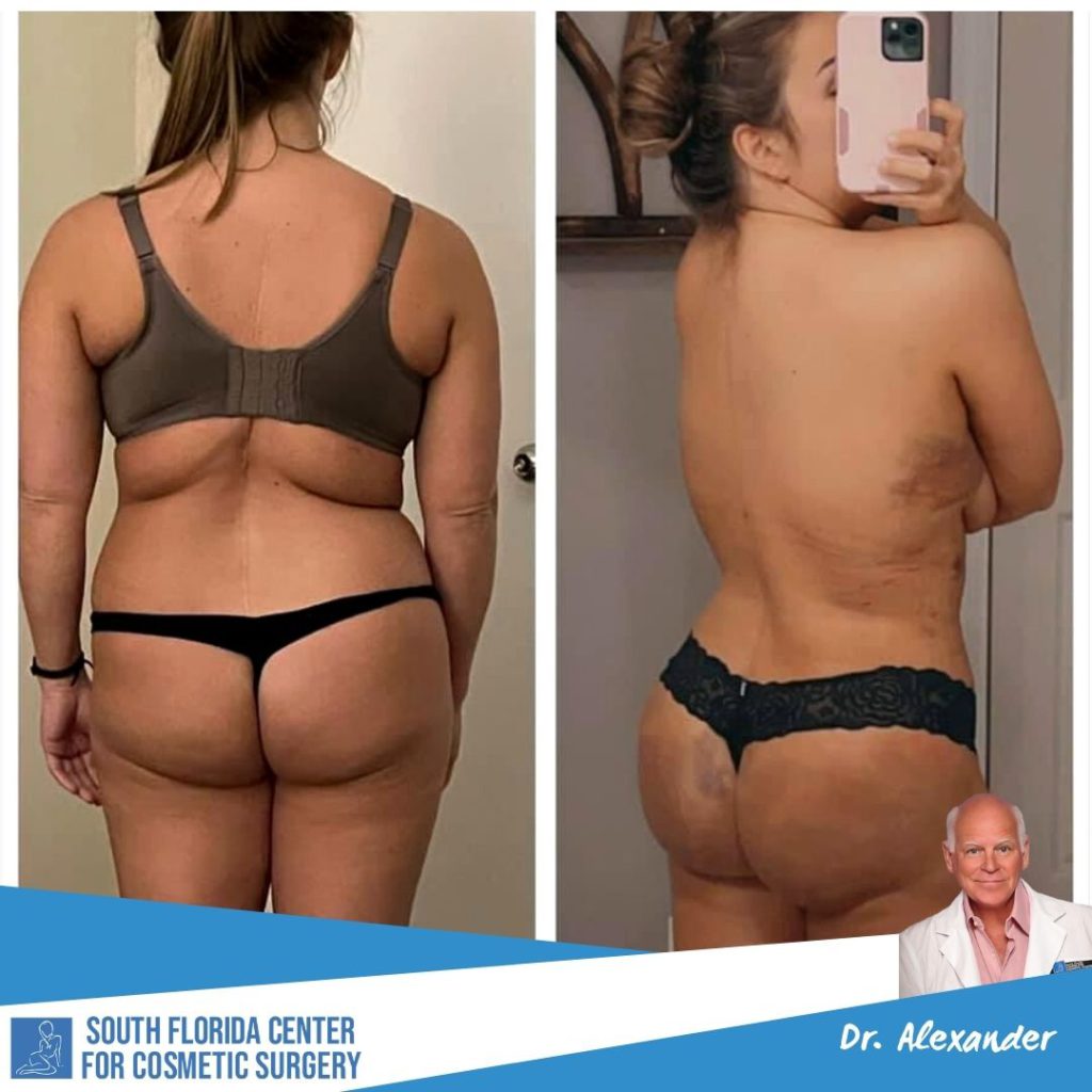 butt injections cost butt injections cost