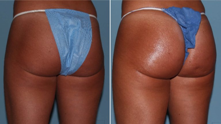 Butt injections cost: Achieving curves with minimally invasive methods