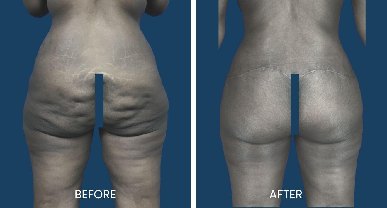 butt lift procedure