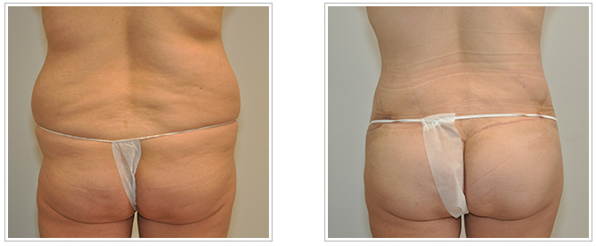 butt lift procedure