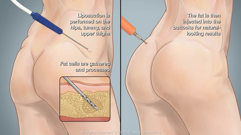 Butt lift procedure: Steps, benefits, and recovery