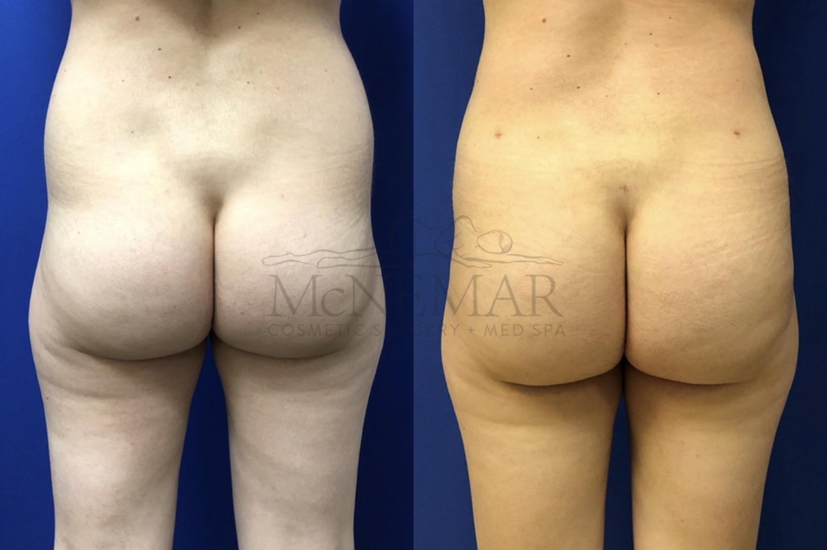 butt lift