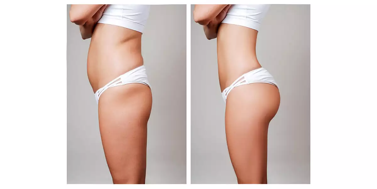butt lift
