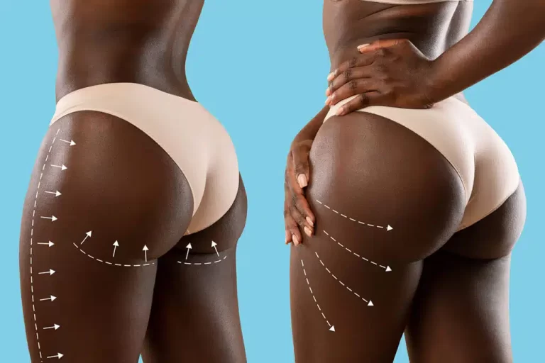 Butt lift: Sculpting curves with precision