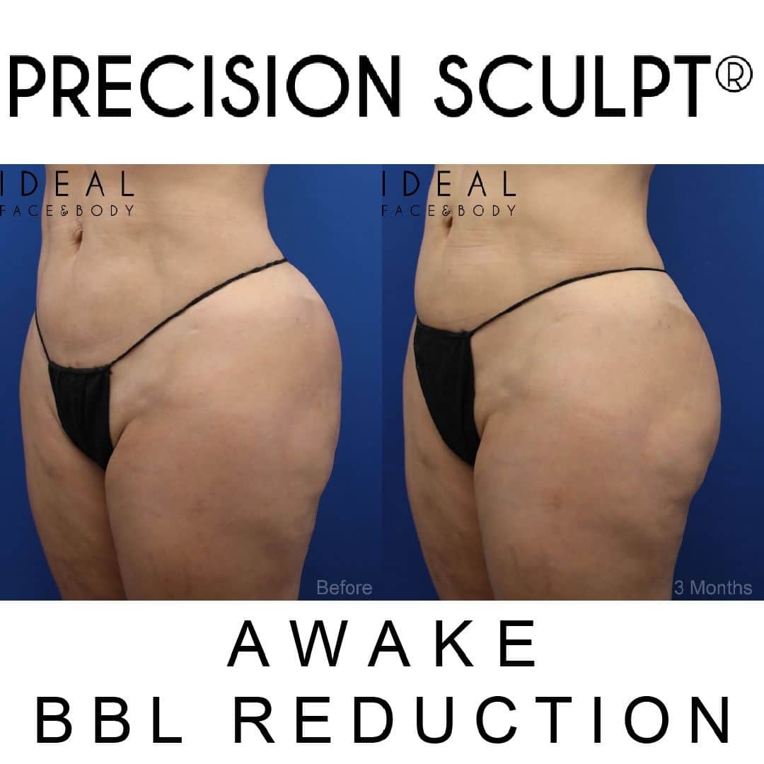 butt reduction