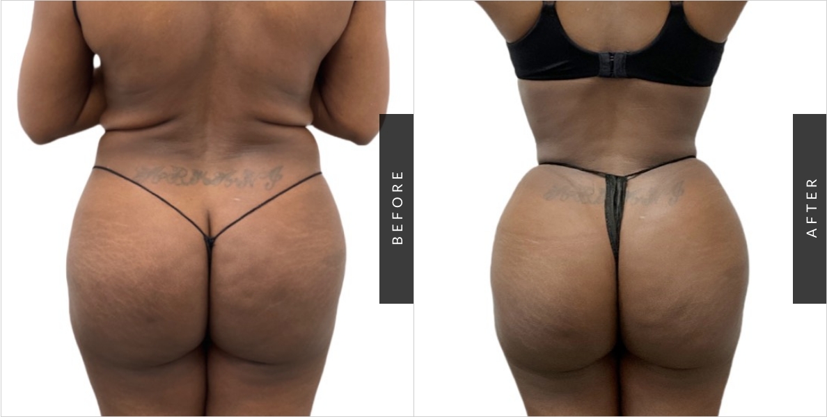 butt reduction