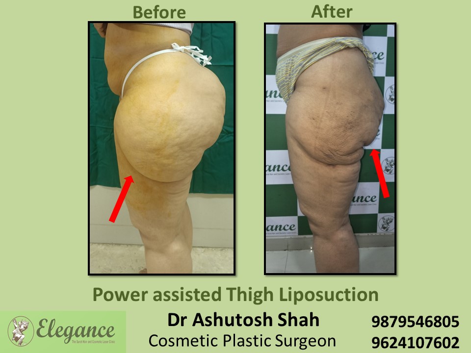 butt reduction