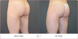 Butt Reduction: Contouring for a balanced look