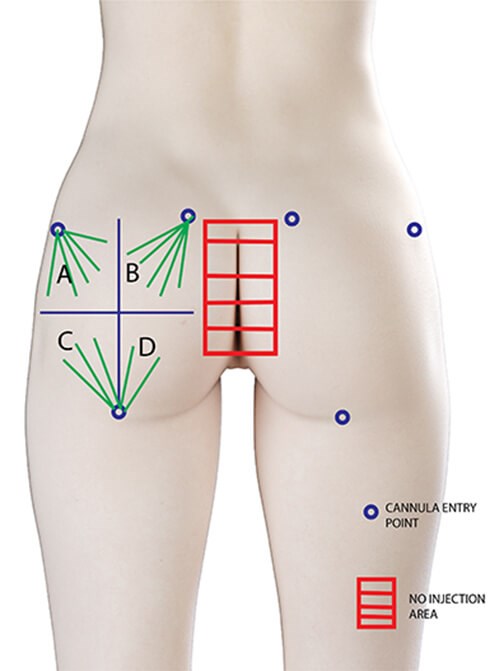 buttock injections
