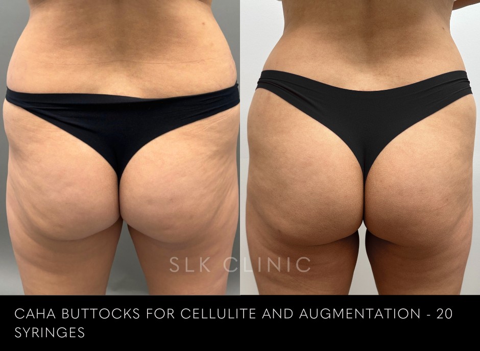 buttock injections