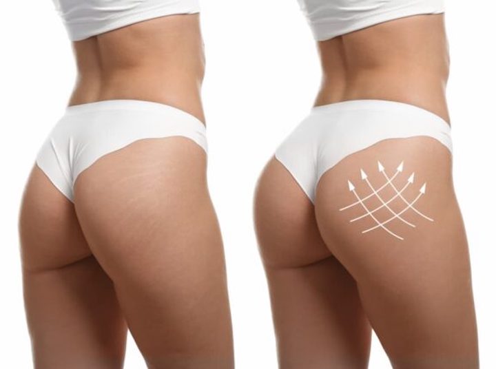 buttock injections
