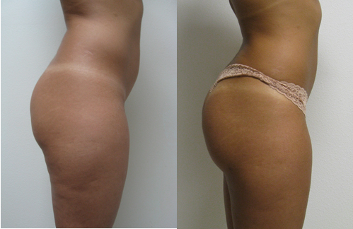 Buttock injections: Enhancing curves with minimally invasive methods