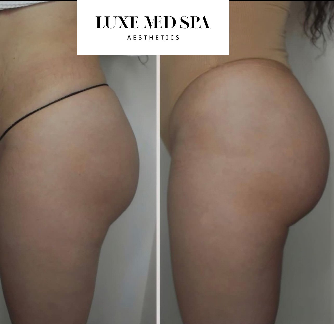 buttock injections prices buttock injections prices