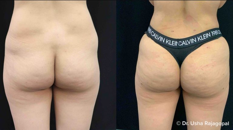 Buttock injections prices: Comparing costs and benefits