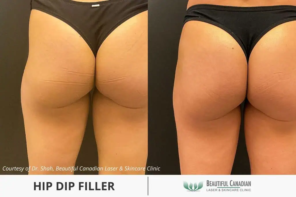buttock injections prices buttock injections prices