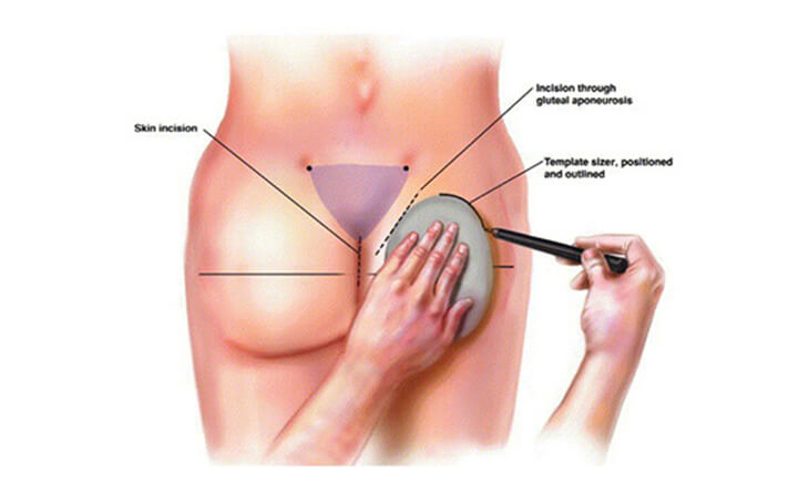 buttocks surgery