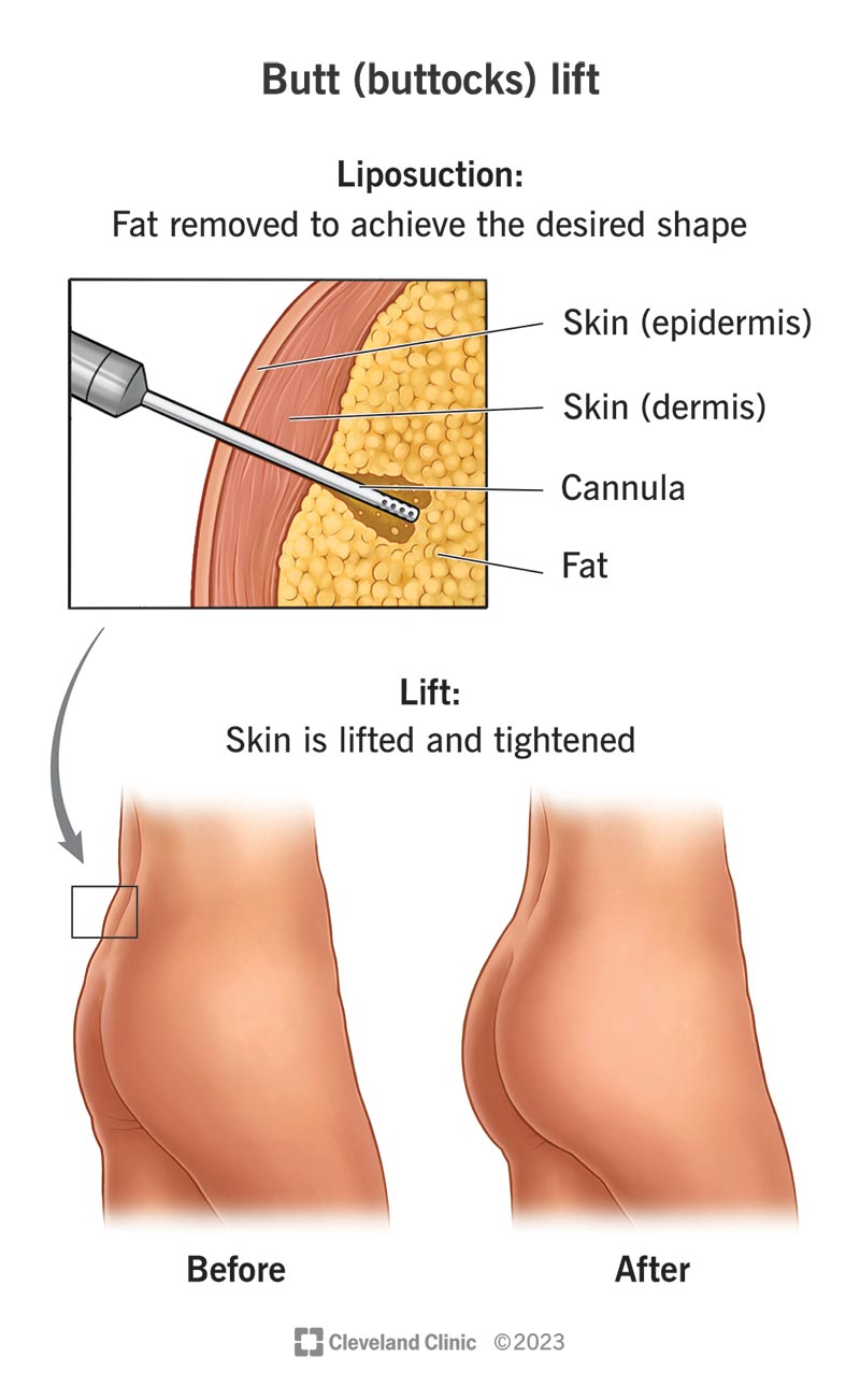 buttocks surgery
