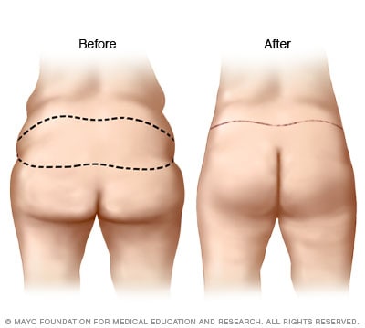 Buttocks surgery: A guide to achieving your ideal shape