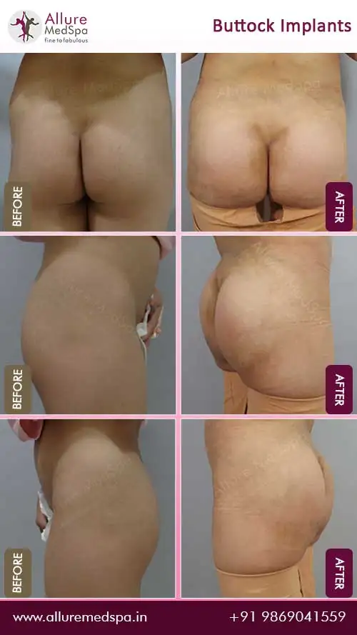 buttocks surgery