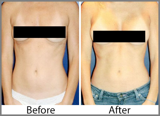 c cup breast implants