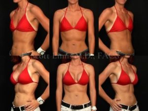 c cup breast implants