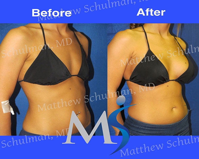 c cup breast implants