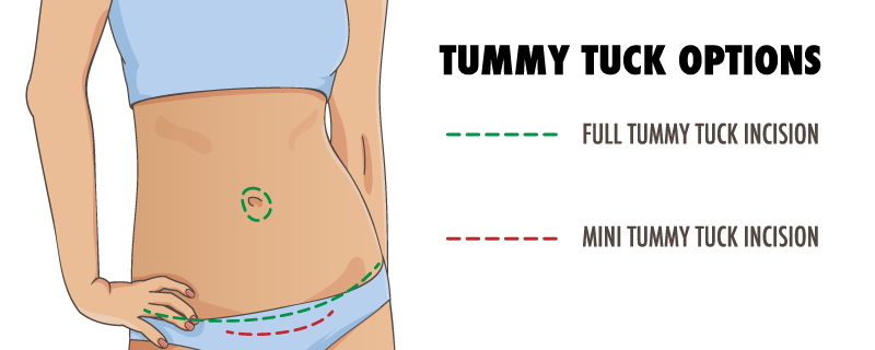 c section tummy tuck c section tummy tuck