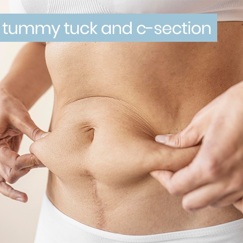 c section tummy tuck c section tummy tuck