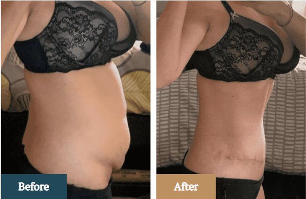 C-Section Tummy Tuck: Combining procedures for convenience