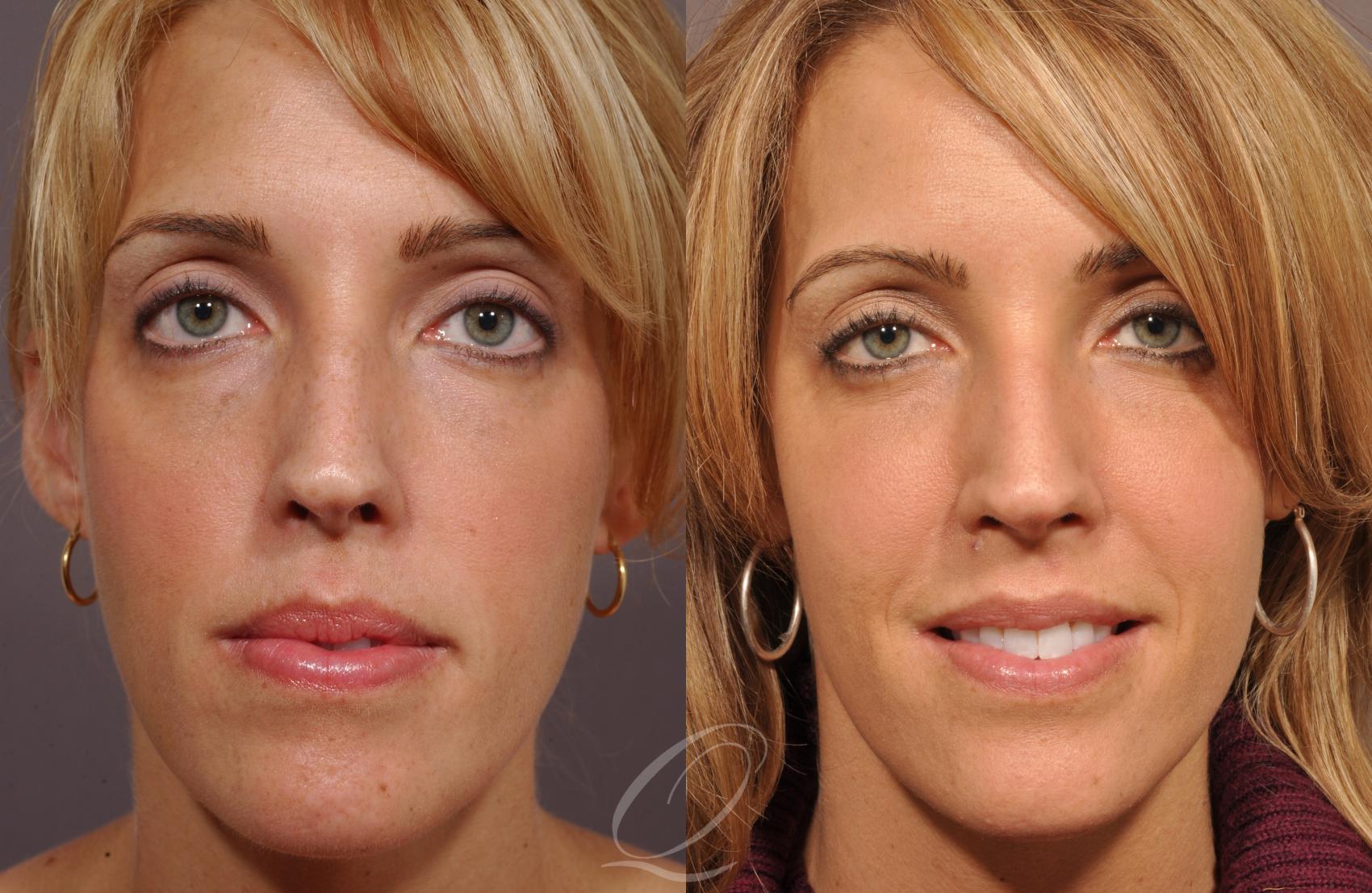 cheek augmentation