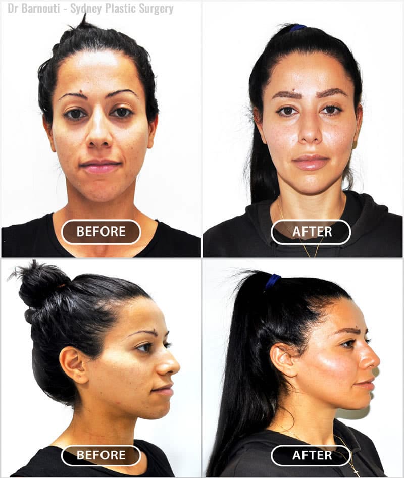 cheek augmentation