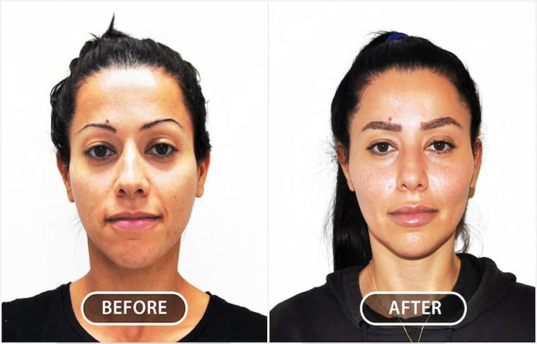 Cheek augmentation: Enhancing facial contours with volume