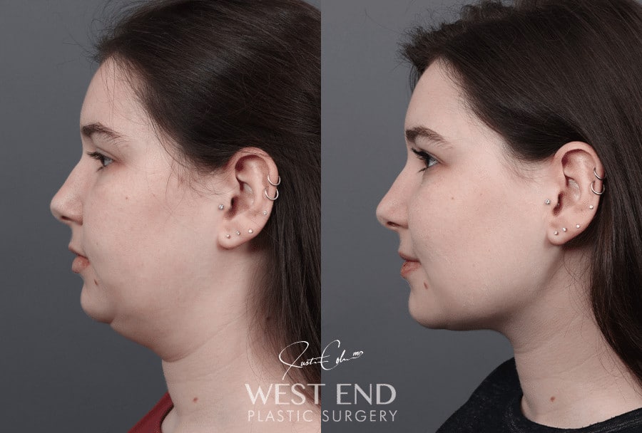 cheek fat reduction cheek fat reduction