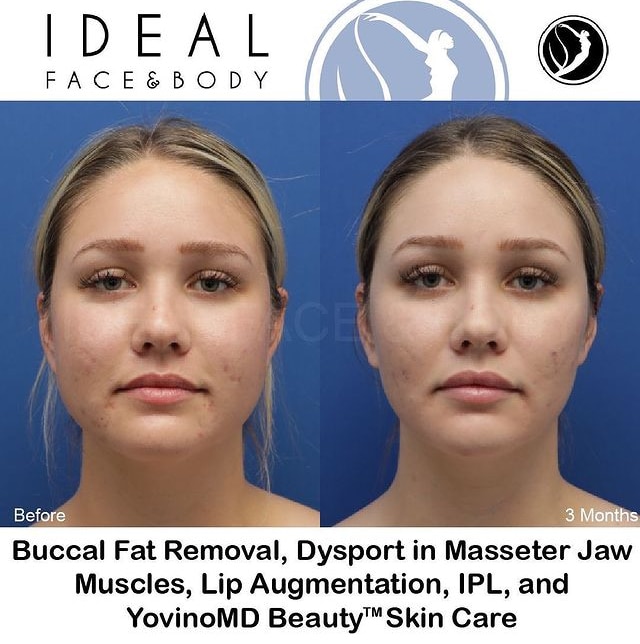 cheek fat reduction cheek fat reduction