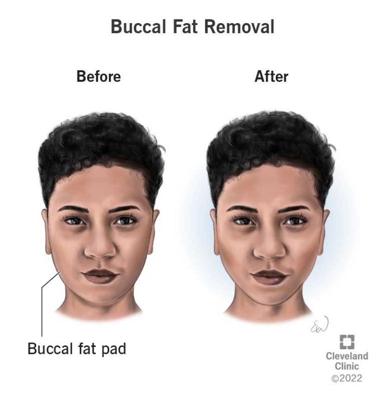 Cheek fat reduction: Slimming and contouring the mid-face