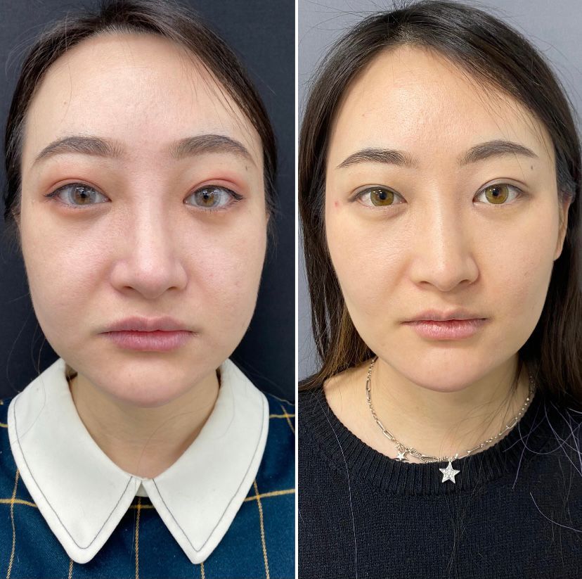 cheek fat reduction cheek fat reduction