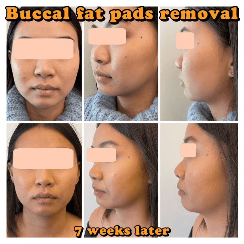 cheek fat reduction cheek fat reduction