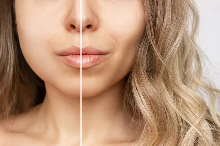 Cheek Fat Removal: Slimming the face with precision